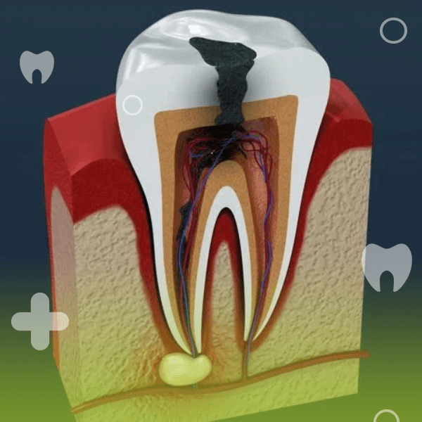 مزایا و معایب عصب کشی دندان